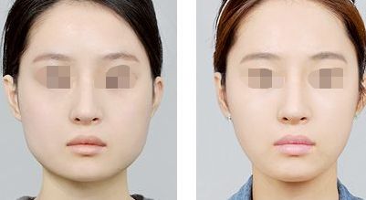 填充鼻唇溝使用玻尿酸安全又有效嗎？