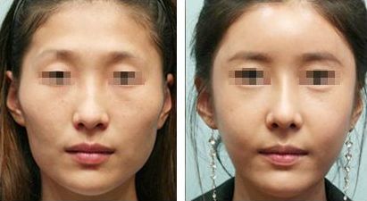 雙眼皮修復(fù)的關(guān)鍵時(shí)期，如何有效解決手術(shù)失敗問題？