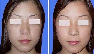 祛除眼袋與抽脂術(shù)哪種更有效？