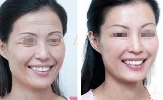 面部吸脂瘦臉效果如何？達(dá)到自然效果的關(guān)鍵是什么