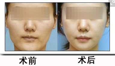 鼻骨矯正對外貌有何影響？矯正費用合理嗎？