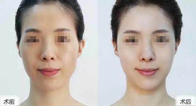 假體隆胸保持持久效果有多久？假體隆胸2個(gè)月后是否固定？