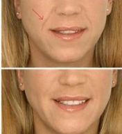 果酸換膚：副作用和危害揭秘，怎樣保護(hù)肌膚安全