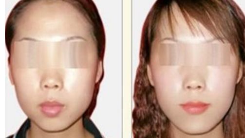 打造明亮迷人雙眼，領(lǐng)略三點雙眼皮手術(shù)的魅力