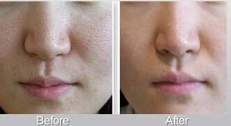 鼻整形手術(shù)后恢復(fù)需要多久？隆鼻與注射隆鼻的恢復(fù)時間對比！