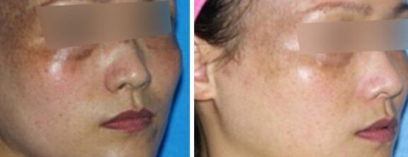 熱瑪吉和黃金超聲炮有何不同？揭秘引發(fā)90%人搞混的區(qū)別！