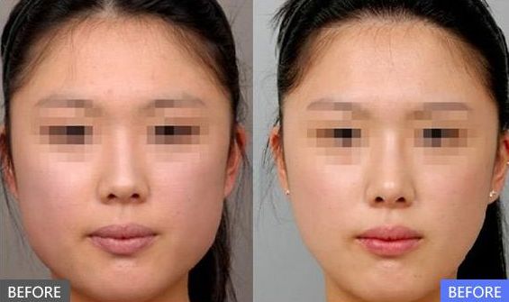 透明質(zhì)酸隆鼻：舒適隆鼻手術讓你更自信