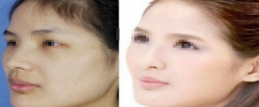 注射隆鼻的價(jià)格預(yù)算是多少呢