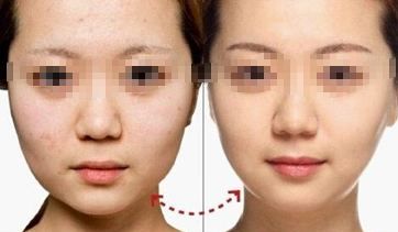 陰道緊縮術(shù)療程多久見效？