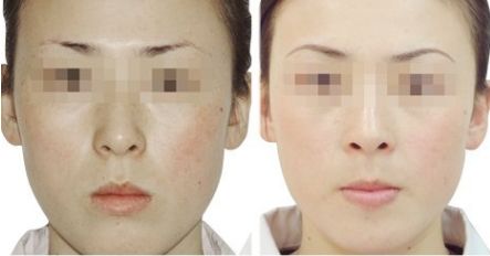 眼袋抽脂術(shù)后出現(xiàn)淤血的原因及處理方法