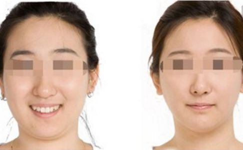 手術整形與微整形區(qū)別及比較：哪個更適合您的需求？