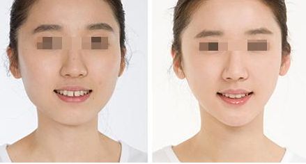 鼻整形手術(shù)價(jià)格分析：效果原理講解，術(shù)后注意事項(xiàng)，不良反應(yīng)剖析