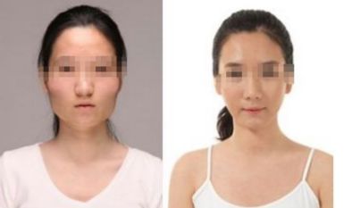 開眼角手術(shù)：完美改善眼部形態(tài)的秘密解析