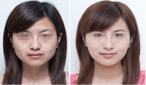 隆鼻手術(shù)后恢復(fù)需要多久時間呢？