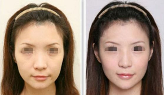 吉大二院種植牙價格及服務詳細解析