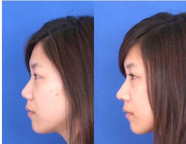 女明星追捧｜熱瑪吉：抗衰神器功效與副作用揭密！