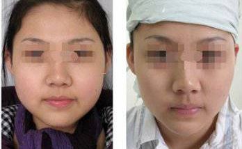 硅膠假體隆胸手術：效果如何？安全程度如何評價？