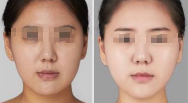 夏季果酸煥膚可否祛除雞皮疙瘩？