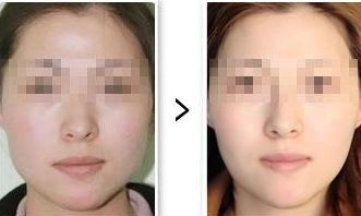 大腿吸脂手術(shù)后需警惕血栓風(fēng)險(xiǎn)