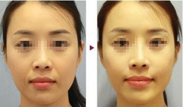 周口六院洗牙價格查詢