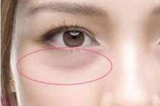 眼瞼外翻問題的療效如何？