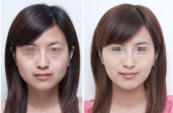 長(zhǎng)曲線下頜角整形手術(shù)能否一次性進(jìn)行截骨操作