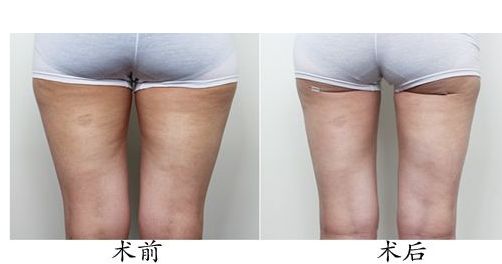 體驗光子嫩膚，解密北京光子嫩膚價格