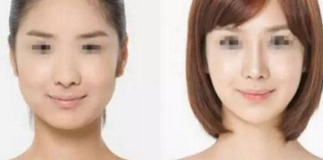 雙眼皮修復(fù)術(shù)最佳時(shí)機(jī)是什么時(shí)候？