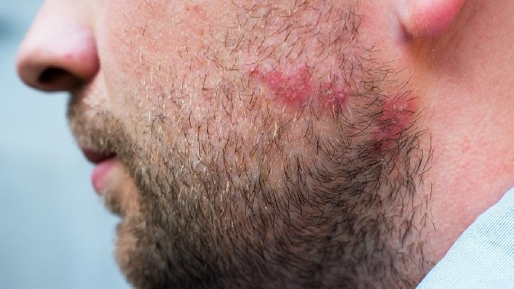 青春痘的去除，激光祛痘是怎么做的呢