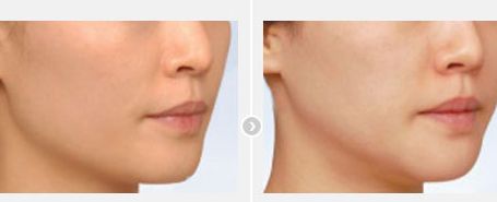 北京最受歡迎的雙眼皮修復(fù)醫(yī)生，多位滿意的患者推薦！