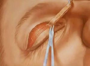 成都美萊醫(yī)生排名榜單：揭曉多名如火如荼的雙眼皮技術(shù)專家