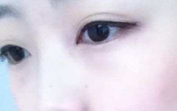 劉月麗醫(yī)生的雙眼皮修復技術(shù)在鄭大二附院備受矚目