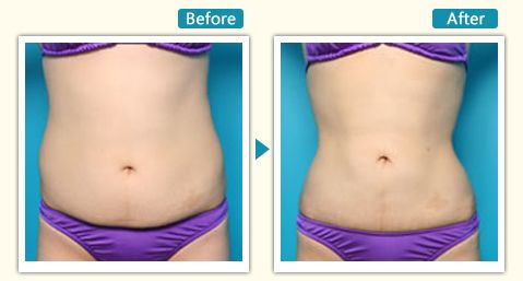 杭州市口碑較好的整形醫(yī)院有哪些？靜港、浙江省人民醫(yī)院、格萊美等入選推薦列表