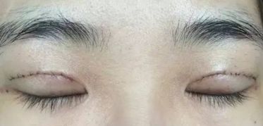 上海王會勇醫(yī)生鼻部整形案例分享：創(chuàng)新技術(shù)助您獲得完美鼻型！