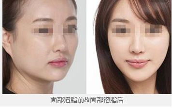 鄭州望京張鵬隆鼻2023年實力及成功案例公開，讓您放心無憂