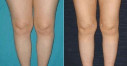 北京哪家醫(yī)院的雙眼皮手術(shù)排名靠前