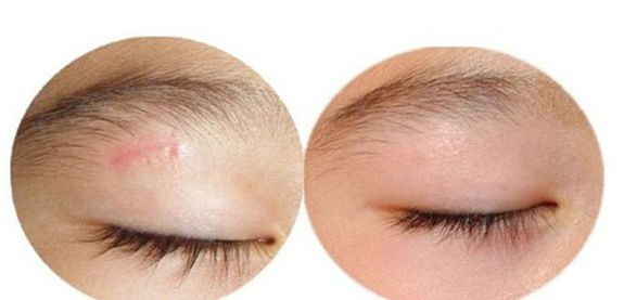 廣州曙光醫(yī)院雙眼皮手術(shù)手藝高超，名醫(yī)推薦！附真實(shí)案例！