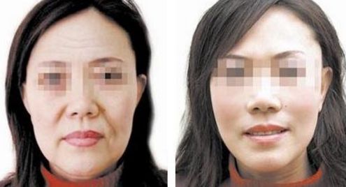 選娜楚玻尿酸還是伊婉？一篇幫你深度對(duì)比分析