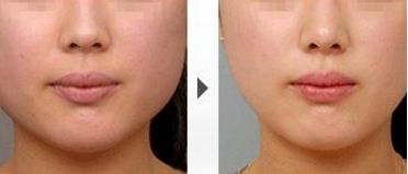 上海五位雙眼皮技術(shù)高超的專家匯總，排名唯一出爐