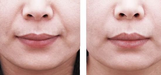 重慶藝星王永久醫(yī)生雙眼皮效果如何？90天招牌案例公開揭曉