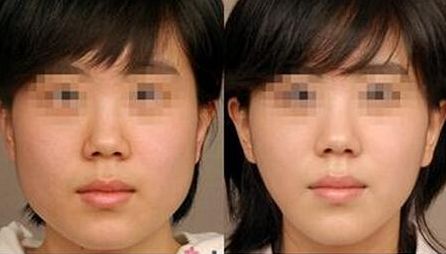 北京下巴自體脂肪墊術哪家醫(yī)院口碑好