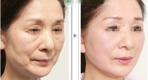 上海哪家磨骨醫(yī)院靠譜？華美、美聯(lián)臣、薇琳資歷雄厚值得信賴