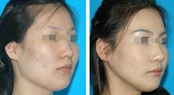 揭秘鵬程整形明星項目，實力專家為您塑美容顏！