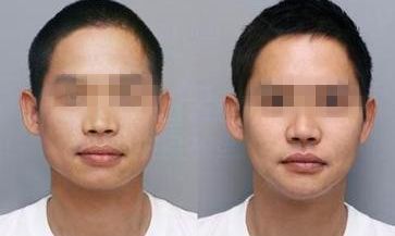 惠州雙眼皮整形醫(yī)院推薦排名：效果認(rèn)證+口碑價(jià)格齊全