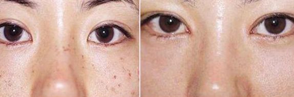 排名前五的廣醫(yī)二院雙眼皮醫(yī)生，價(jià)格參考2023