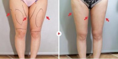 常州哪家醫(yī)院做玻尿酸效果好？