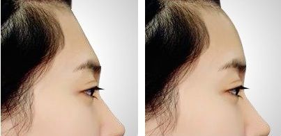 【2023年最受歡迎的福州鼻部整形醫(yī)生排行榜，效果口碑和價(jià)格點(diǎn)評(píng)】