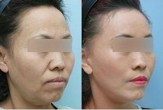 杭州吸脂手術(shù)哪家醫(yī)院可靠