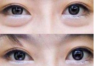 朝陽區(qū)雙眼皮手術就找TA！專家力推朝陽二醫(yī)院頂級雙眼皮醫(yī)生