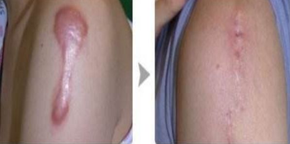 董玉林受眾好評！感受不一樣的眼部整形風(fēng)格及預(yù)算參考董玉林雙眼皮手術(shù)讓您煥然一新！